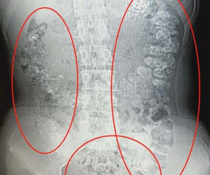 Cô bé 14 tuổi 5 ngày không đi đại tiện, kết quả chụp CT khiến nhiều người sốc vì có vô số “vật thể lạ”: Nguyên nhân là do trà sữa