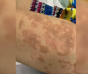 Chủ quán cơm tạt cả chảo dầu đang sôi vào người đàn bà hàng xóm