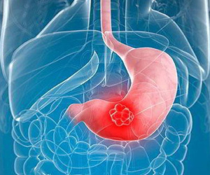 Người đàn ông 31 tuổi bị ung thư dạ dày do ăn thứ này thay cơm trong thời gian dài