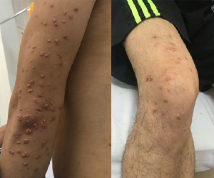 Tự ý nặn những nốt mụn ngoài da, không ngờ đi khám đó là u vàng phát ban rối loạn lipid máu hỗn hợp