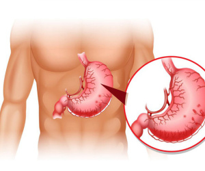 Tại sao bệnh dạ dày lại có thể tiến triển thành ung thư: Nhiều người không chú ý điều này