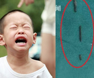 Cháu bé 8 tuổi thường xuyên đau đớn đến phát khóc, đến viện kiểm tra mới biết dị vật bị 'bỏ quên' trong cổ tới 6 năm