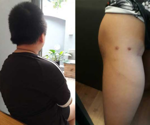 Nghi án bố cùng dì ghẻ bạo hành con trai dã man suốt nhiều năm ở Phú Thọ: Đốt túi bóng nhỏ vào mông, bắt nhặt cơm dưới đất lên ăn