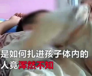 Thấy cháu đi khập khiễng, ông mua canxi cho uống nhưng tình trạng ngày càng tồi tệ vì thứ dị vật mắc kẹt trong người suốt 6 năm