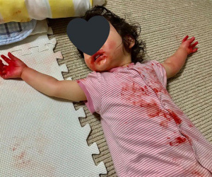 Vắng mặt ít phút, mẹ suýt ngất khi thấy con gái nằm im, khắp người toàn màu đỏ
