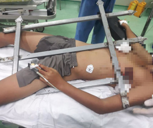 Trèo cây ngã xuống, cậu bé 13 tuổi bị chông hàng rào đâm xuyên dọc ngực
