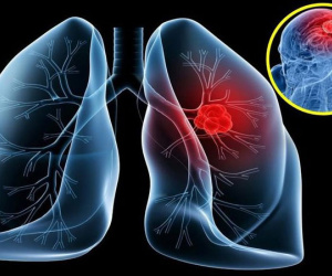 Mắc 4 bệnh ung thư, người phụ nữ vẫn sống khỏe mạnh