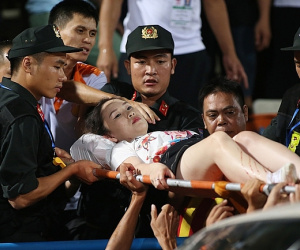CĐV nữ bị bỏng lưu huỳnh vào tận xương do pháo sáng, phải phẫu thuật 2 lần