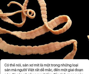 Sán xơ mít sống trong bụng bệnh nhân nhiều năm do thói quen ăn uống mà hầu như người Việt nào cũng mắc