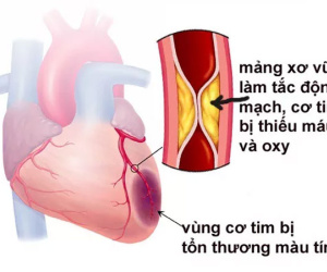 Căn bệnh khiến NSND Thế Anh qua đời là nguyên nhân gây đột tử hàng đầu, nhiều người trẻ mắc