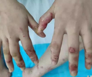 Chân tay lở loét chỉ vì ăn cá, cô gái 19 tuổi ngỡ ngàng khi bác sĩ tiết lộ nguyên do đằng sau