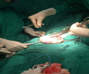 Hút 2 lít dịch, cắt bỏ thành công khối u 'khủng' của người phụ nữ