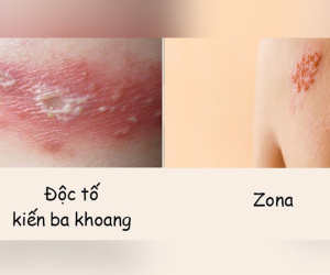 Phân biệt vết thương do kiến ba khoang với viêm da do zona để tránh dùng sai thuốc khiến bệnh càng khó chữa