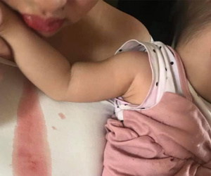 Ông bố Việt hút thuốc lá rồi ôm hôn con, bé 14 tháng nôn 7 lần/ngày, đứng không vững