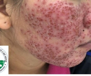 Mặt tiền tan nát, vỡ mộng trắng sáng vì lột da bằng hóa chất