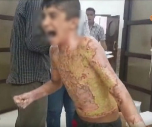 Dư luận quốc tế chấn động trước một loạt hình ảnh trẻ em Syria với những vết bỏng nặng, khoét sâu vào cơ thể do vũ khí hóa học gây ra