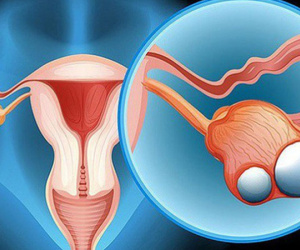 Cô gái 23 tuổi chưa kết hôn đã bị ung thư dạ dày di căn buồng trứng, cảnh báo những thói quen xấu nhiều người mắc