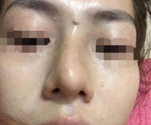 Giấu mẹ đi nâng mũi giá 2 triệu lại được trả góp, bé gái 13 tuổi ở Yên Bái bị mù một bên mắt