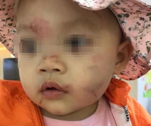 Bé gái 14 tháng tuổi bị nhiều vết bầm tím trên mặt ngay ngày đầu đến lớp