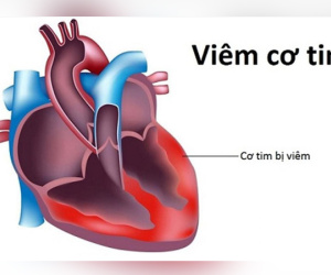 Thực hư virus viêm cơ tim gây chết người đang xôn xao cộng đồng mạng