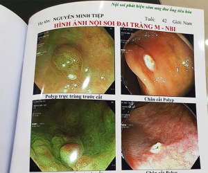 Bệnh polyp đại tràng và polyp dạ dày mà diễn viên Minh Tiệp vừa phát hiện có thể tiến triển thành ung thư không?
