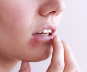 Những nhầm tưởng về mụn rộp sinh dục herpes mà không ít phụ nữ mắc phải