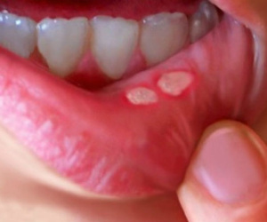 Nhiệt miệng không nguy hiểm, tại sao nhiều trẻ vẫn nguy kịch tính mạng?