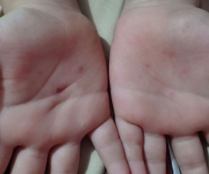 Cô giáo mầm non bị tố dùng vật nhọn đâm vào tay bé trai 5 tuổi
