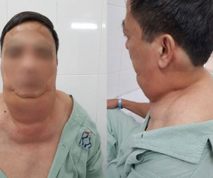 Uống rượu 40 năm, người đàn ông bị biến dạng mặt và cổ