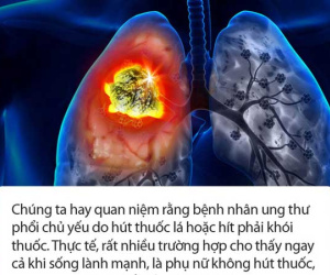 Không bao giờ hút thuốc và ăn uống rất lành mạnh nhưng 3 phụ nữ sau vẫn bị ung thư phổi