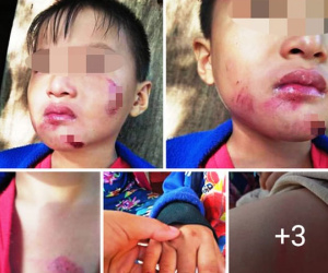 Bé trai 6 tuổi nghi bị chính mẹ ruột bạo hành dã man