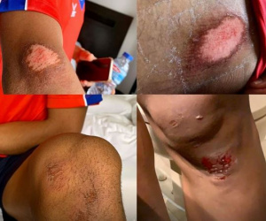 Hãi hùng với hình ảnh thương tích đầy mình của U22 Campuchia sau trận ra quân trên mặt sân cỏ nhân tạo