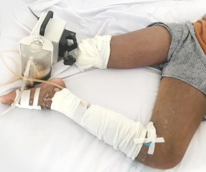 Thầy lang trị rắn độc cắn bằng cách cắt lễ, bé gái 13 tuổi nhận cái kết bi thương