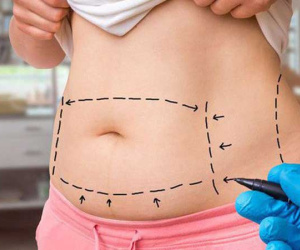 Đừng chủ quan với từng vùng cơ thể khi thẩm mỹ hút mỡ vì đã có trường hợp gặp biến chứng mưng mủ nặng vì hút mỡ đùi