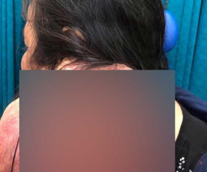 Một phụ nữ được phẫu thuật thành công khối u vùng cổ khổng lồ hiếm gặp