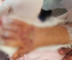 6 giờ đồng hồ căng thẳng, bằng phẫu thuật vi phẫu bác sĩ nối bàn tay phải đứt gần rời cho bé gái 3 tuổi