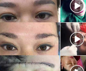 Những hình ảnh rạch da đầu bóc mỡ nâng chân mày, nâng mí sụp, tiêm filler nâng mũi cùng lúc khiến nhiều người kinh hãi