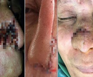 Cần Thơ: Cháu nhậu say cắn mũi bác rồi nuốt luôn vào bụng