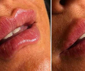 Bơm 'Môi gợn sóng': Trào lưu làm đẹp kỳ quái và nguy cơ kinh hoàng