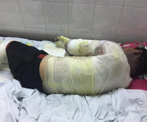 Nổ can đựng xăng, hai vợ chồng nguy kịch