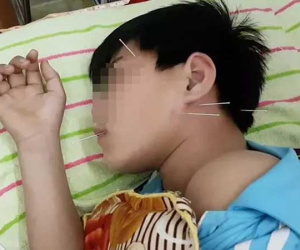 Liệt dây thần kinh số 7 ở trẻ nhỏ, đừng làm điều này nếu không muốn hại con