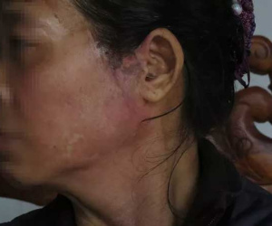 Nỗi đau của người vợ bị chồng nhẫn tâm hắt nước sôi vào mặt