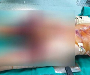Nam sinh 13 tuổi dập nát bàn tay vì học cách chế pháo trên mạng