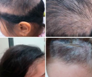 Hoang mang con gái 9 tuổi nhổ trụi mảng tóc, mẹ khóc khi biết nguyên nhân từ chính mình