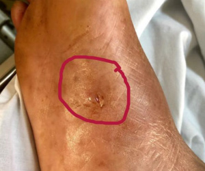 Chỉ với vết thương nhỏ xíu này nhưng nếu bạn không xử lý kịp thời thì có thể dẫn đến suy hô hấp, ngừng thở