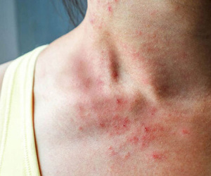 Cẩn thận với nguy cơ mắc bệnh tiểu đường trong dịp Tết nếu bạn gặp phải 2 triệu chứng ngứa từ cơ thể