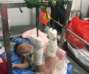 Thông tin mới nhất về sức khỏe của bé 4 tháng tuổi bị bố đánh gãy chân, xuất huyết não