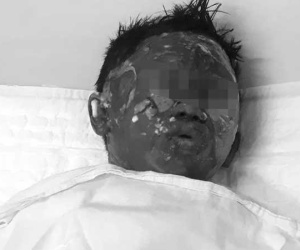 Cháu bé 6 tuổi bị dì ruột tẩm xăng đốt hiện ra sao?