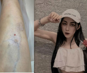 Hot girl bị teo cơ sau xóa sẹo thâm, cảnh báo điều chị em vẫn thích làm