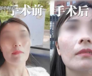Tin vào 'bí quyết vượng phu', người phụ nữ vung tiền đến viện thẩm mỹ để thay đổi nhân tướng, kết quả khiến cô và bạn trai thất vọng